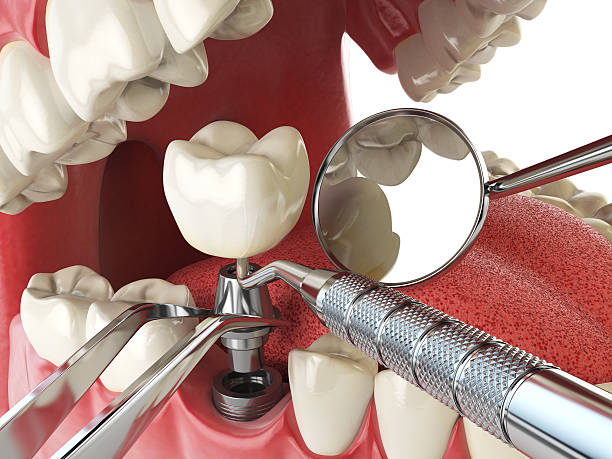 Best Emergency Tooth Extraction in Monroeville, IN